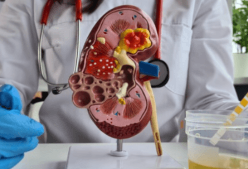 Acute Kidney Injure(AKI) Care